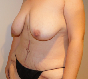 After Image: Post-Massive Weight Loss Surgery - left-front-oblique