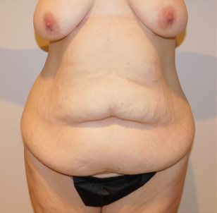 Before Image: Post-Massive Weight Loss Surgery - front