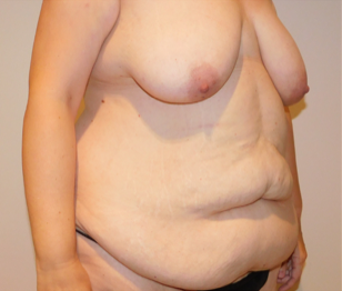 Before Image: Post-Massive Weight Loss Surgery - right-front-oblique