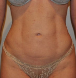 After Image: Standard Liposuction