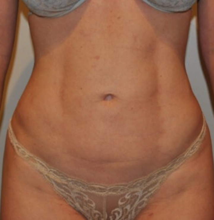 After Image: Standard Liposuction - front