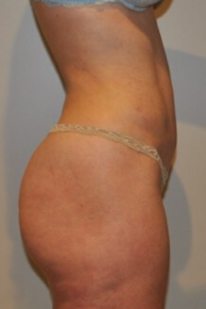 After Image: Standard Liposuction - right-side