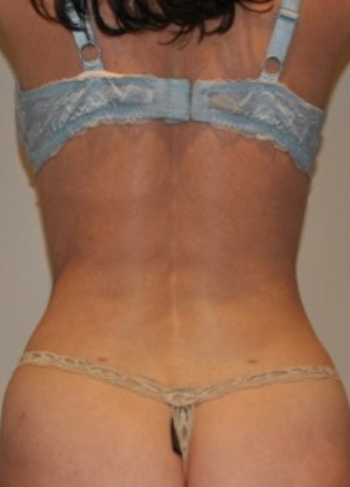 After Image: Standard Liposuction - back