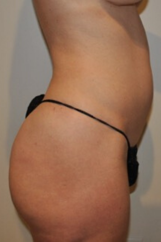 Before Image: Standard Liposuction - right-side