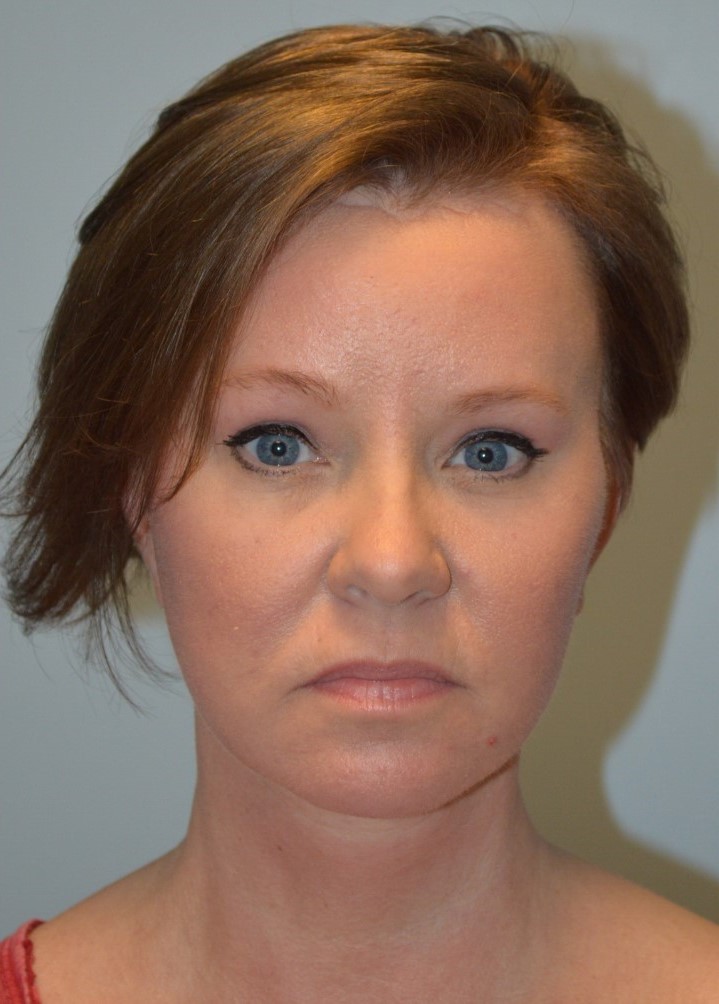 After Image: Facelift and Neck Lift - front