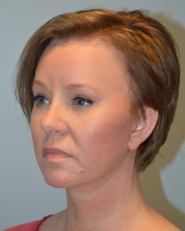 After Image: Facelift and Neck Lift - left-front-oblique