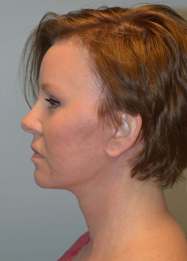 After Image: Facelift and Neck Lift - left-side