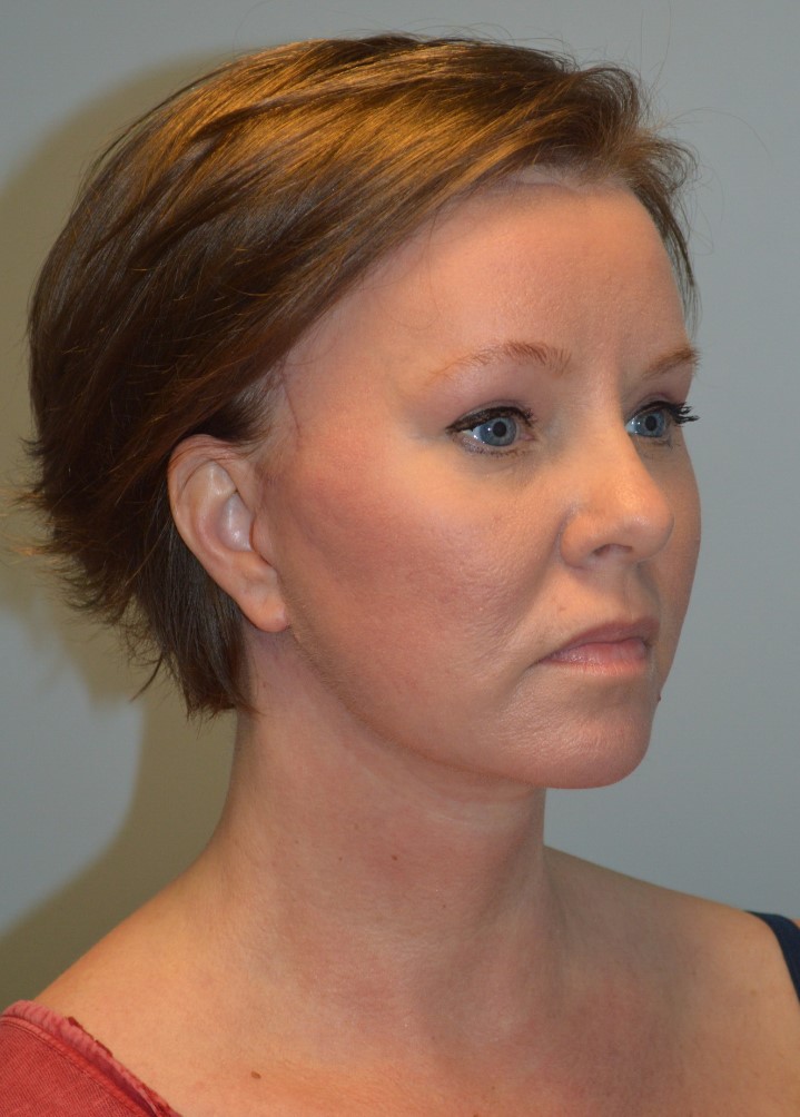 After Image: Facelift and Neck Lift - right-front-oblique