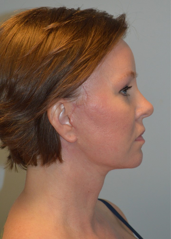 After Image: Facelift and Neck Lift - right-side