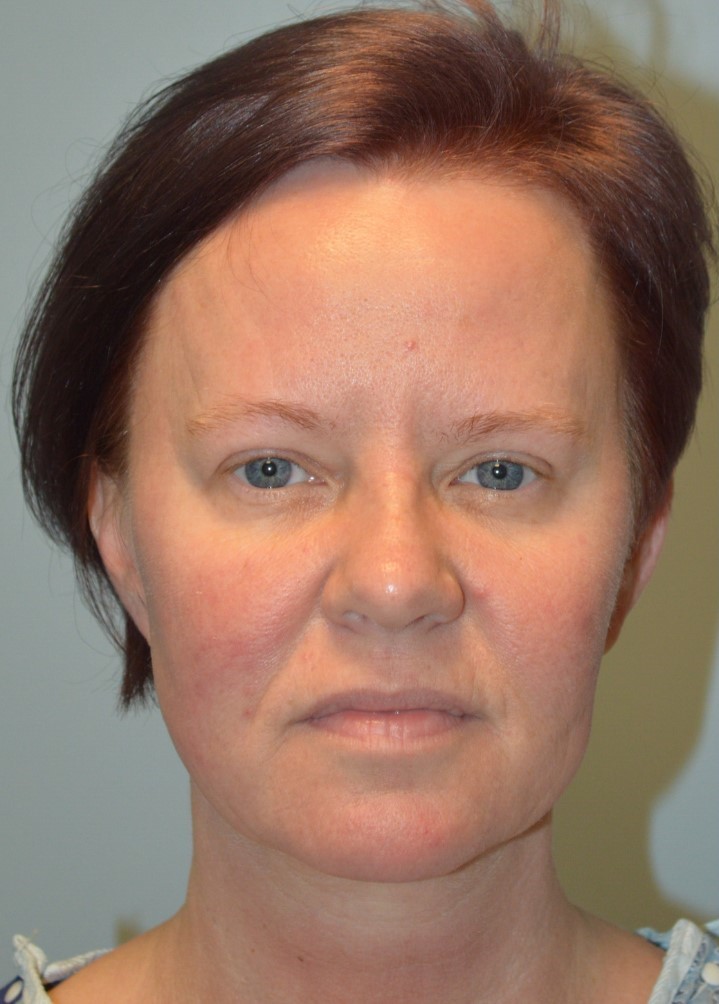 Before Image: Facelift and Neck Lift - front