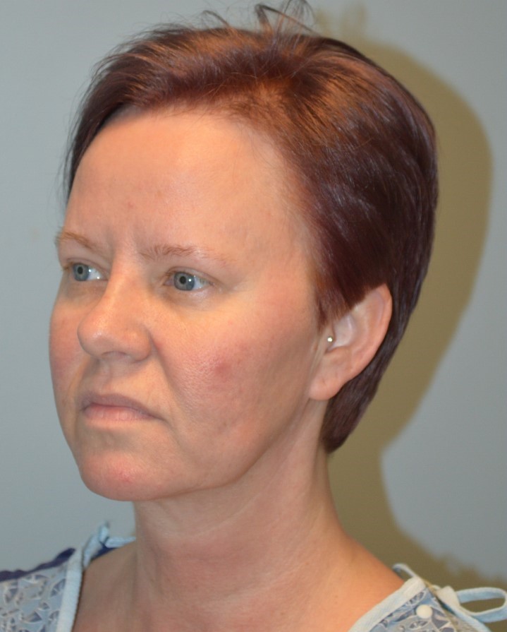 Before Image: Facelift and Neck Lift - left-front-oblique