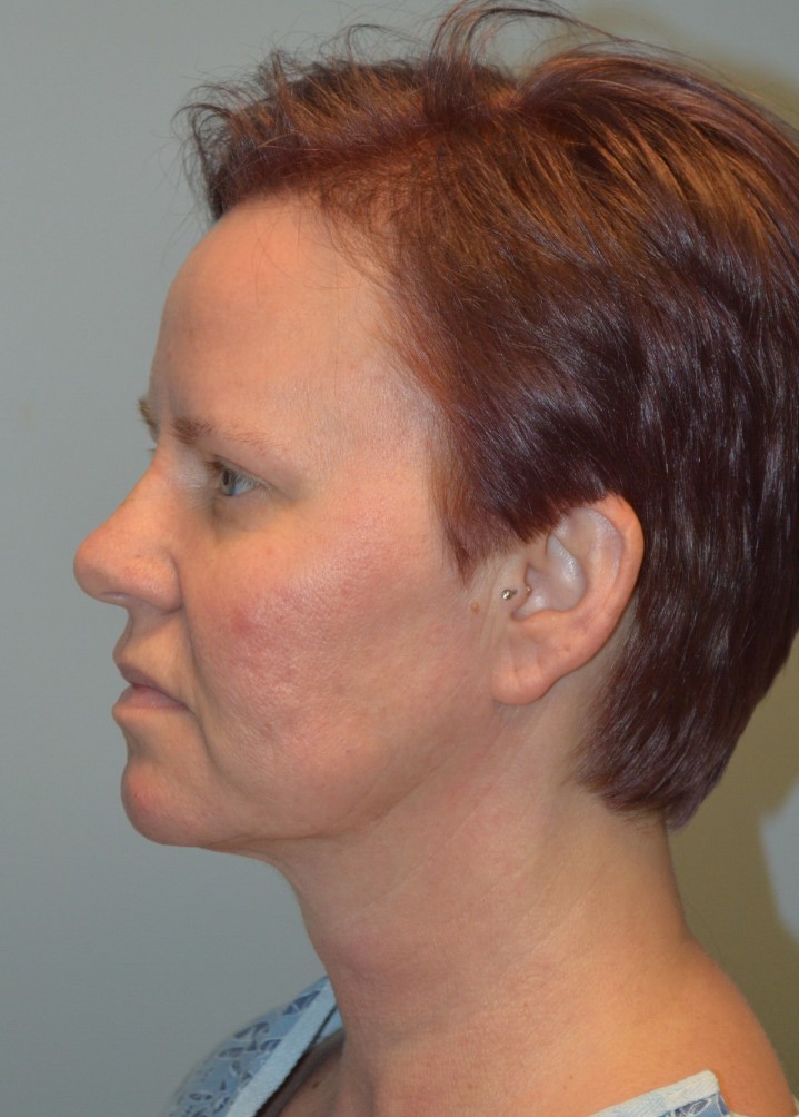 Before Image: Facelift and Neck Lift - left-side