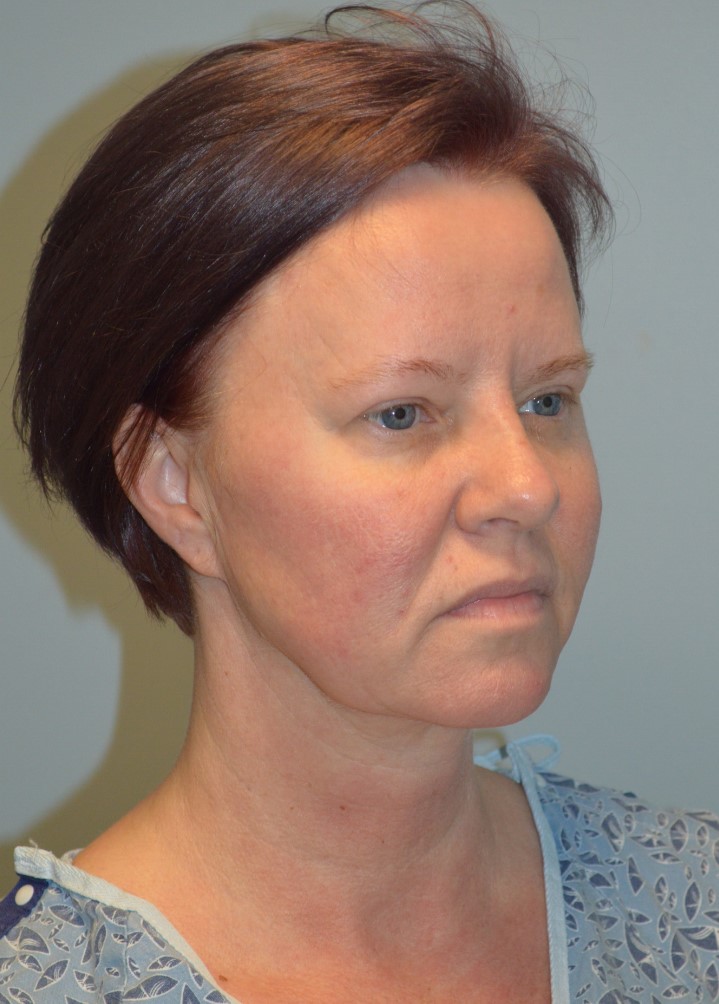 Before Image: Facelift and Neck Lift - right-front-oblique