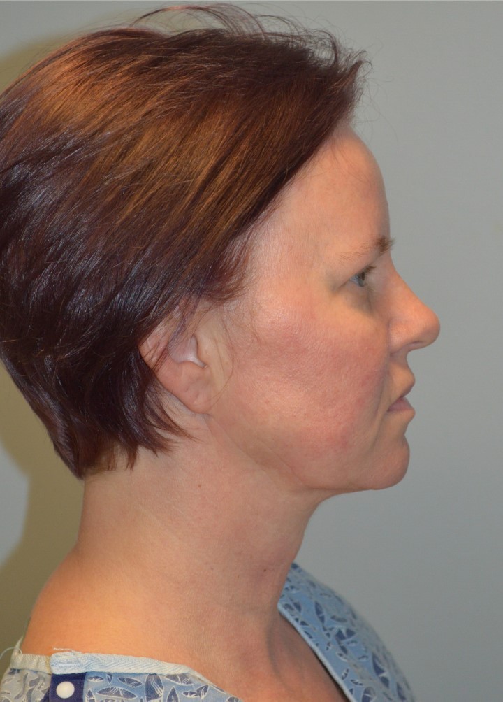 Before Image: Facelift and Neck Lift - right-side