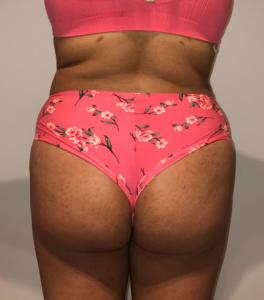 After Image: Brazilian Buttock Lift