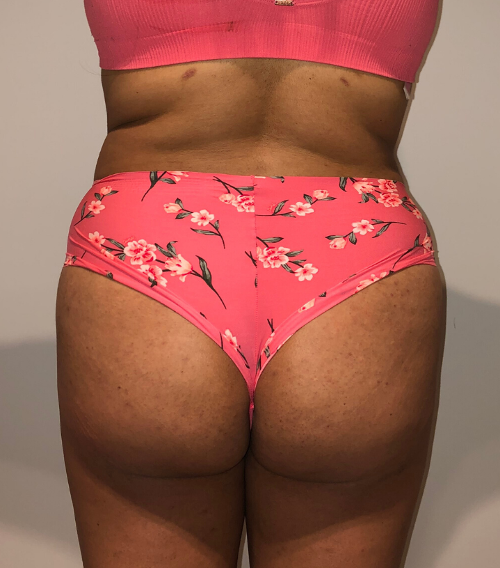 After Image: Brazilian Buttock Lift - back