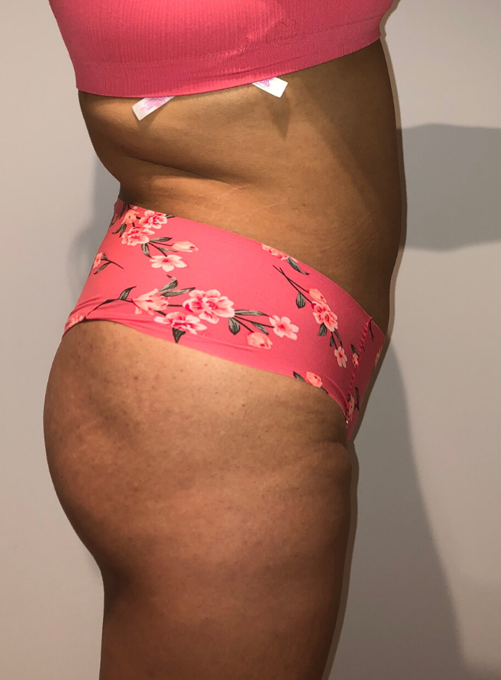 After Image: Brazilian Buttock Lift - right-side