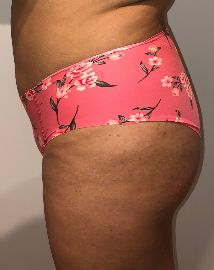 After Image: Brazilian Buttock Lift - left-side