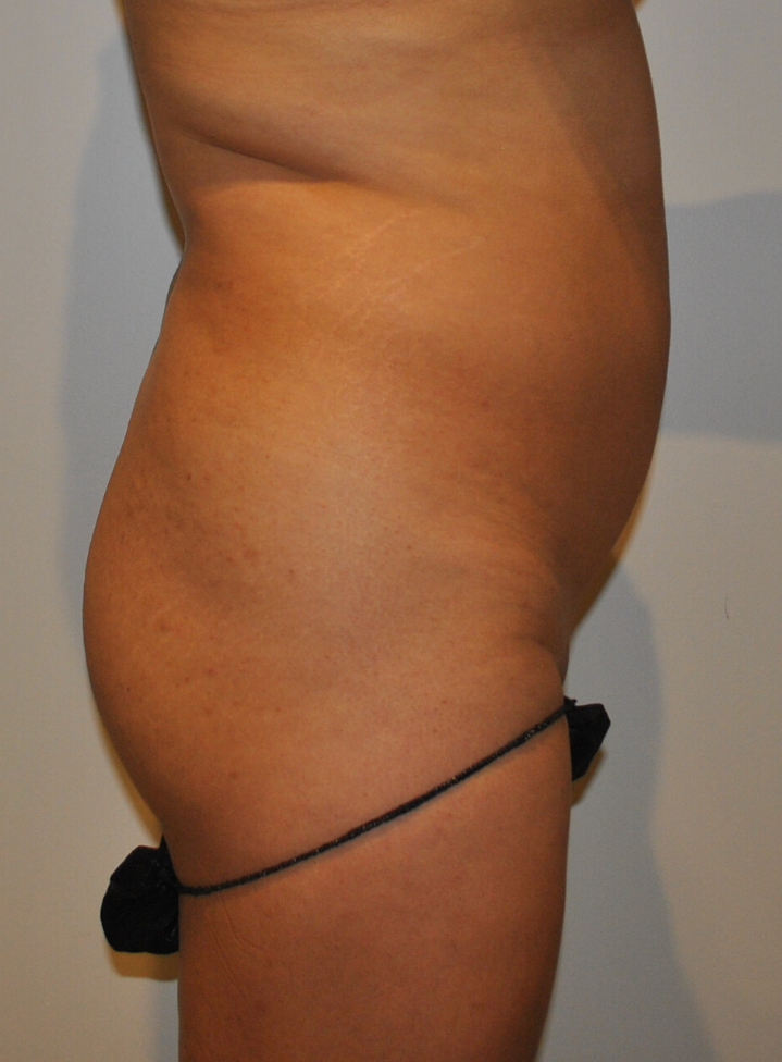 Before Image: Brazilian Buttock Lift - right-side