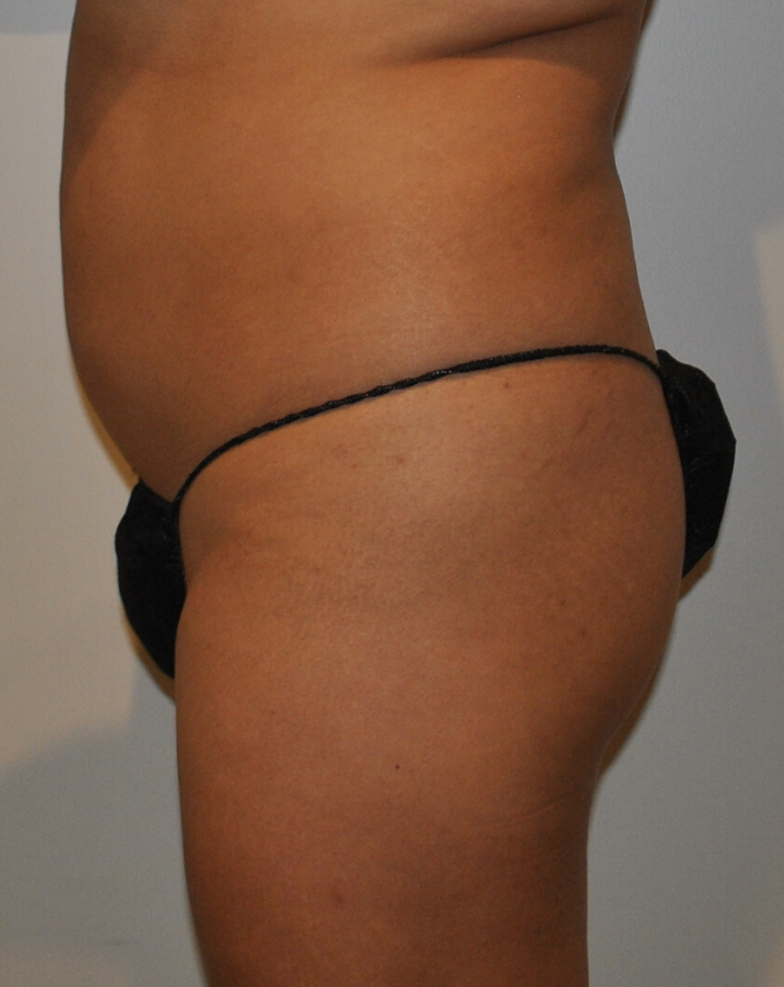 Before Image: Brazilian Buttock Lift - left-side