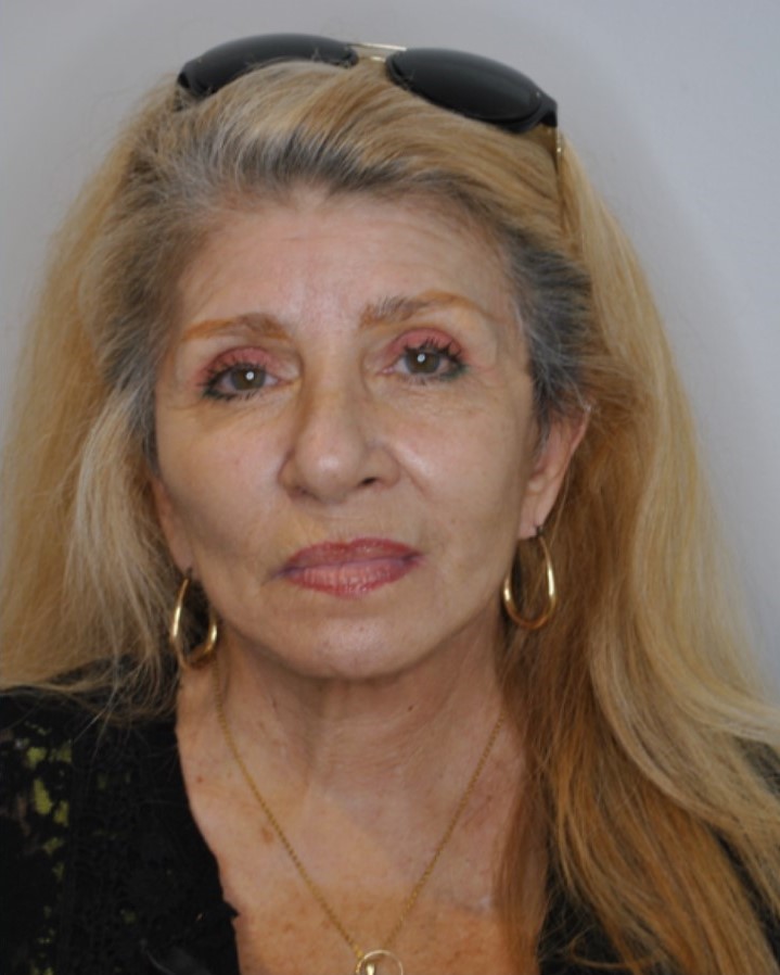 After Image: Facelift and Neck Lift - front