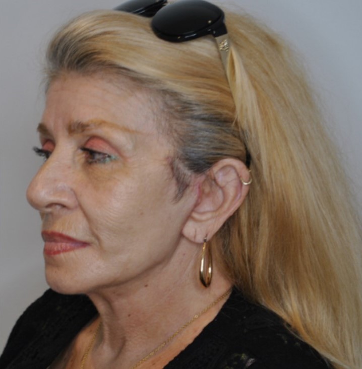 After Image: Facelift and Neck Lift - left-front-oblique