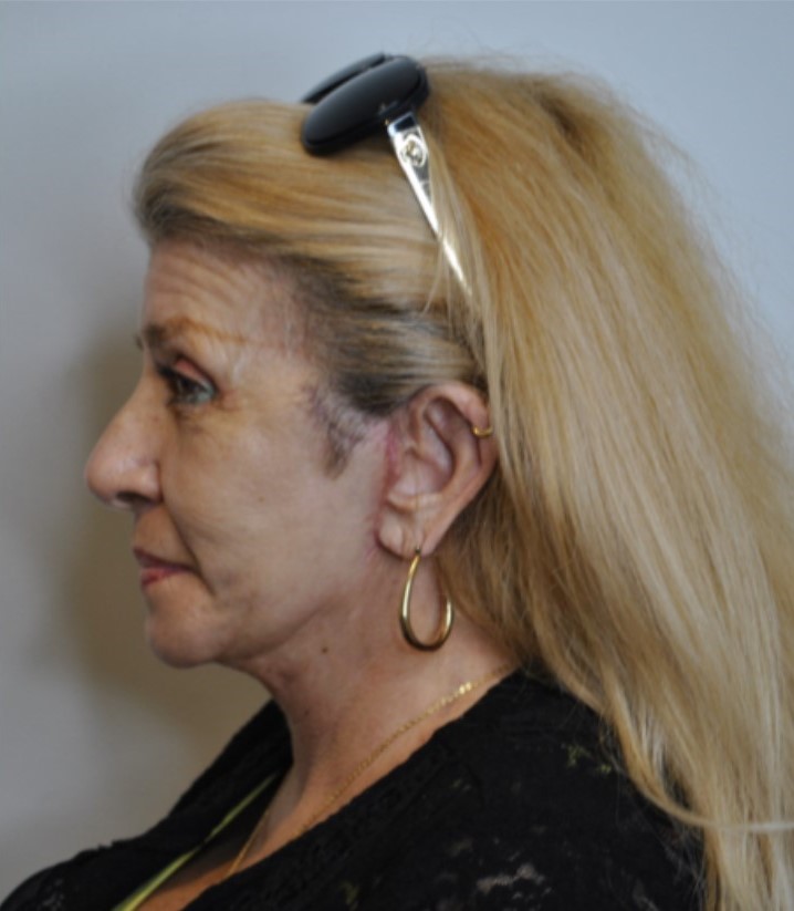 After Image: Facelift and Neck Lift - left-side