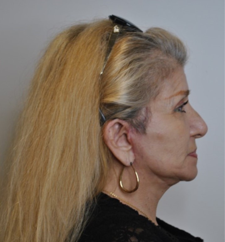 After Image: Facelift and Neck Lift - right-side