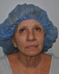 Before Image: Facelift and Neck Lift