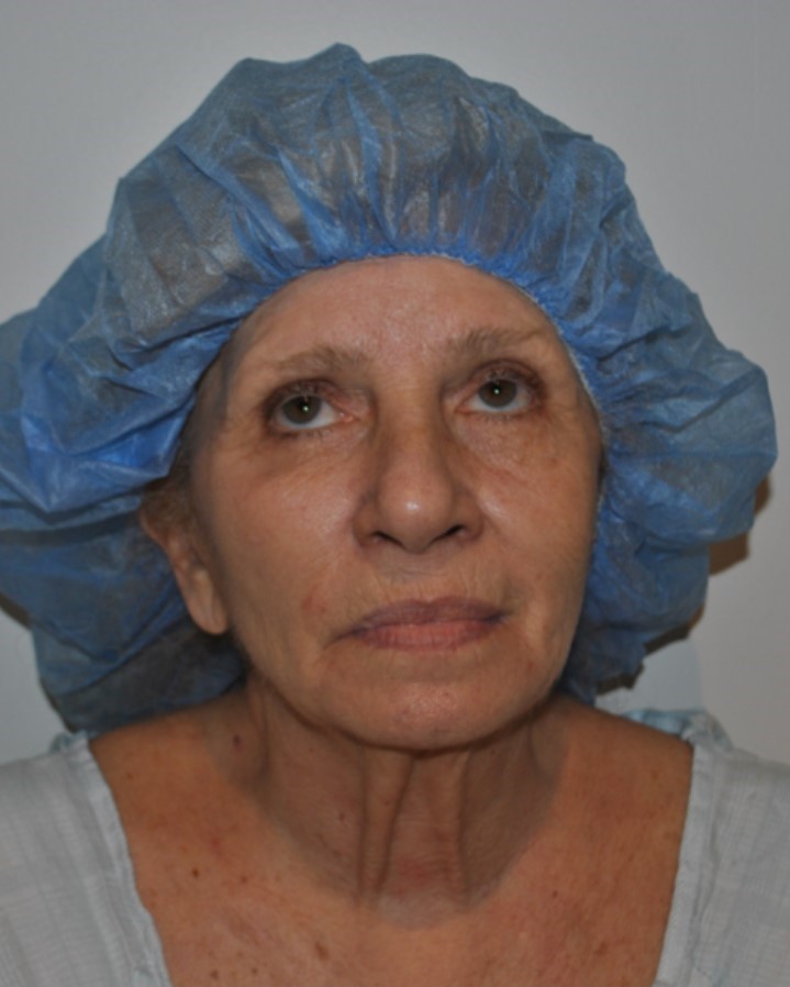 Before Image: Facelift and Neck Lift - front