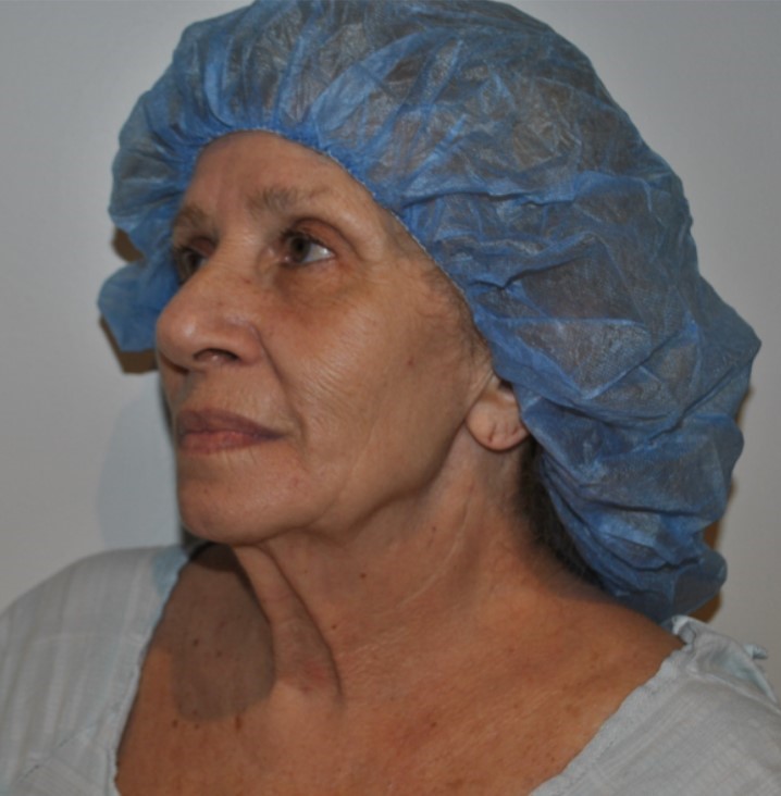 Before Image: Facelift and Neck Lift - left-front-oblique