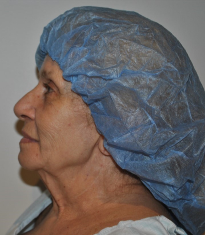 Before Image: Facelift and Neck Lift - left-side