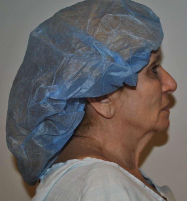 Before Image: Facelift and Neck Lift - right-side