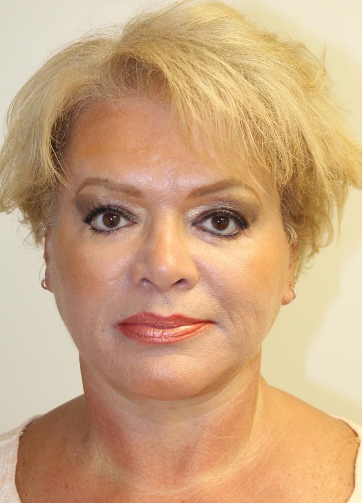 After Image: Facelift and Neck Lift - front