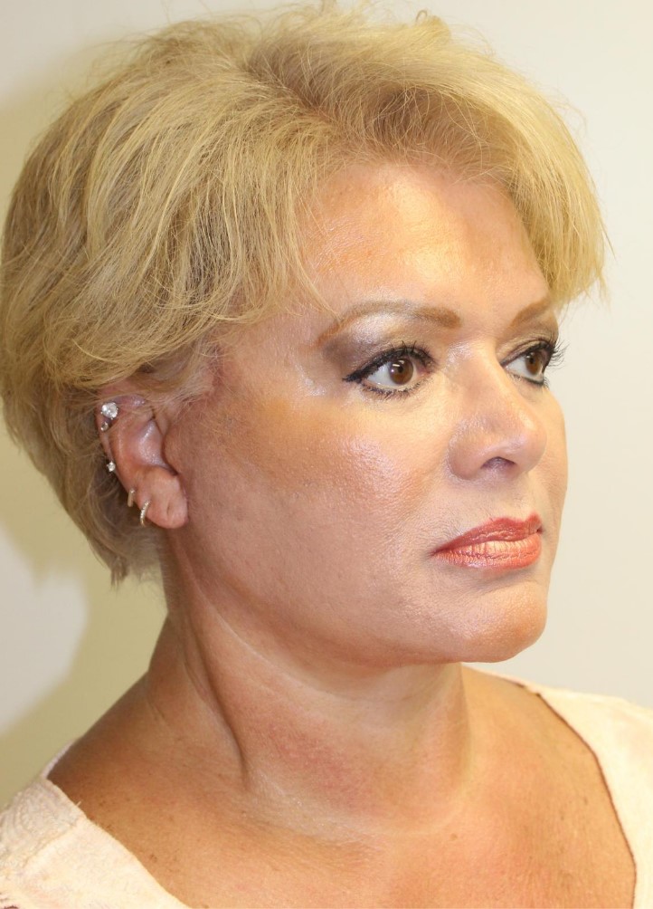 After Image: Facelift and Neck Lift - right-front-oblique