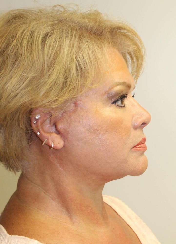 After Image: Facelift and Neck Lift - right-side