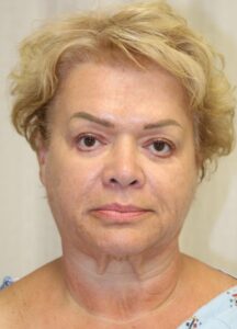 Before Image: Facelift and Neck Lift