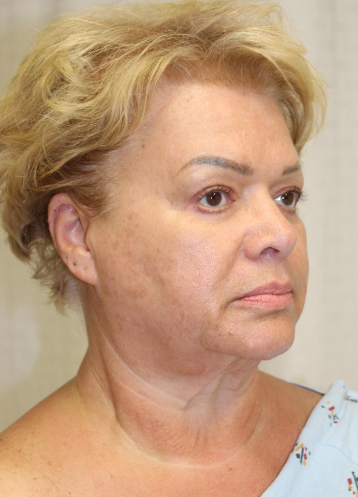 Before Image: Facelift and Neck Lift - right-front-oblique