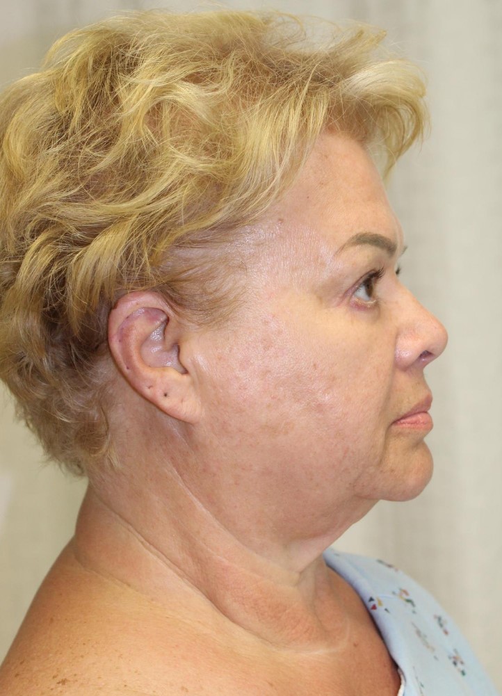 Before Image: Facelift and Neck Lift - right-side