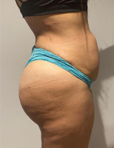 After Image: Brazilian Buttock Lift