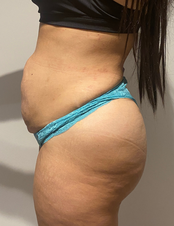 After Image: Brazilian Buttock Lift - left-side