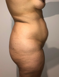 Before Image: Brazilian Buttock Lift