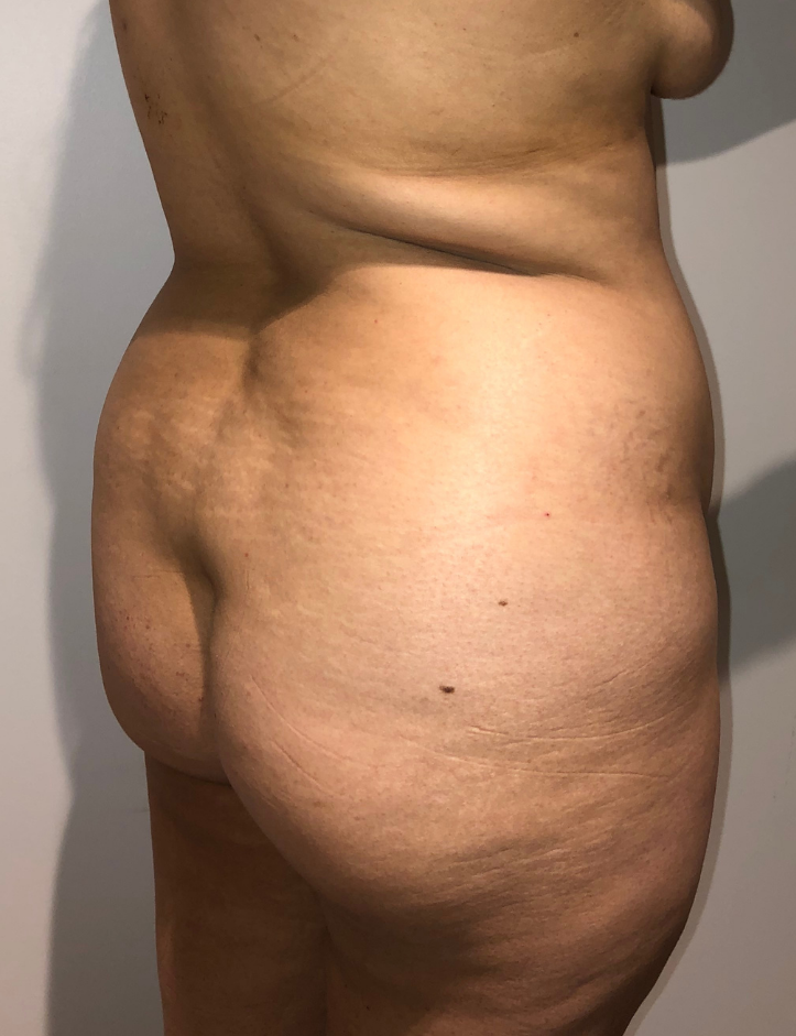 Before Image: Brazilian Buttock Lift - right-back-oblique