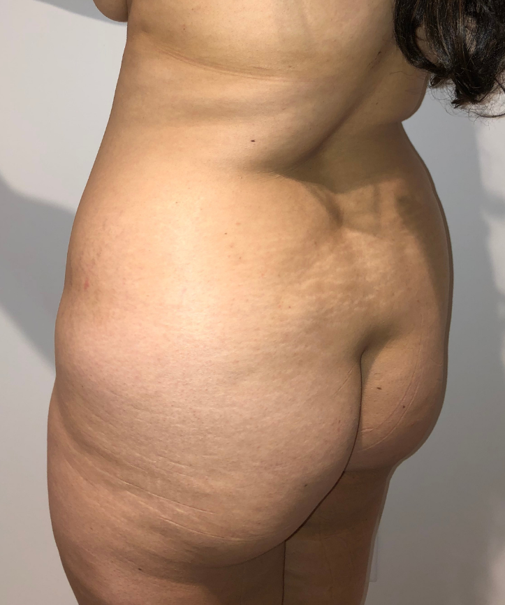 Before Image: Brazilian Buttock Lift - left-back-oblique