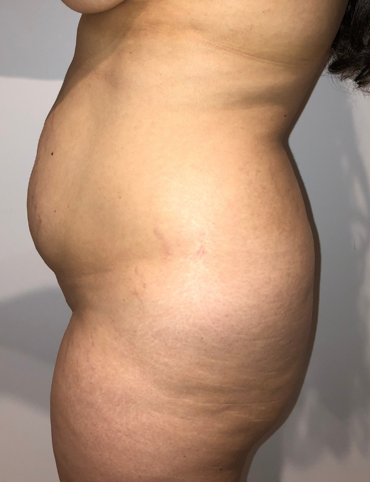 Before Image: Brazilian Buttock Lift - left-side