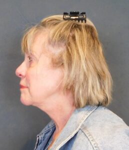 After Image: Facelift and Neck Lift