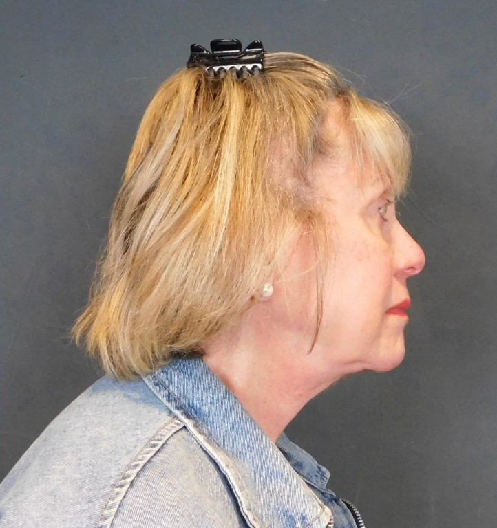 After Image: Facelift and Neck Lift - right-side