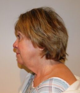 Before Image: Facelift and Neck Lift