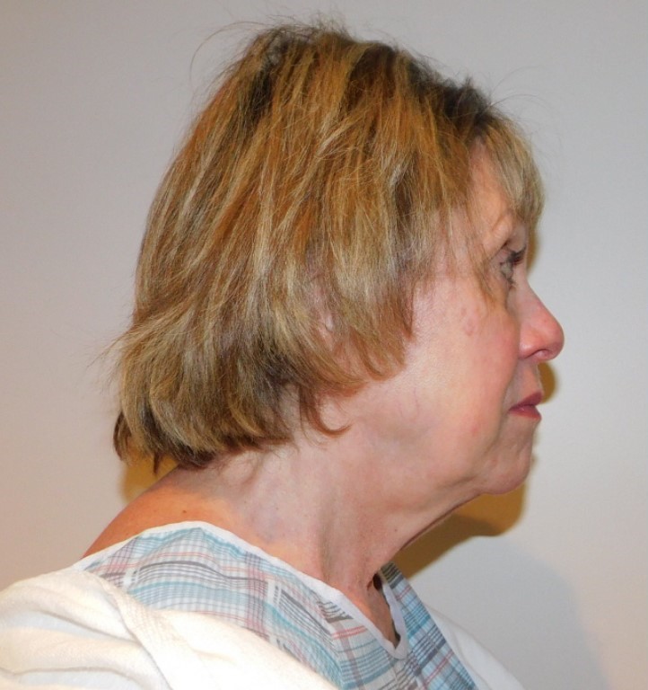 Before Image: Facelift and Neck Lift - right-side