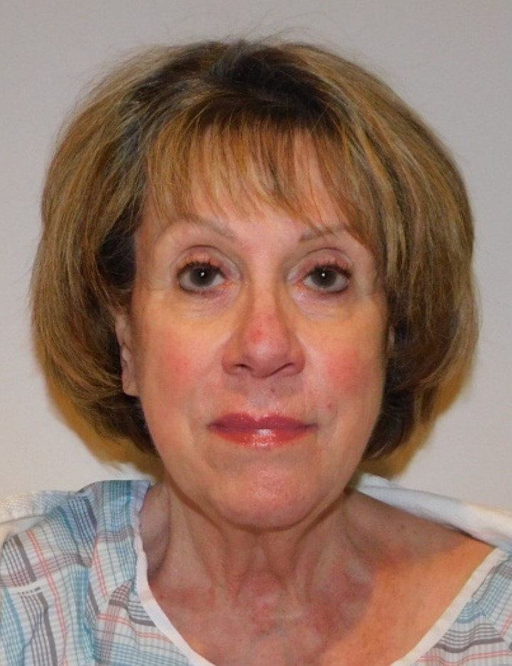 Before Image: Facelift and Neck Lift - front